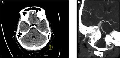 Comatose With Basilar Artery Occlusion: Still Odds of Favorable Outcome With Recanalization Therapy